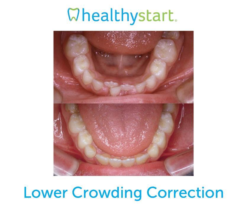 Pediatric Dentist Braces Mission Viejo