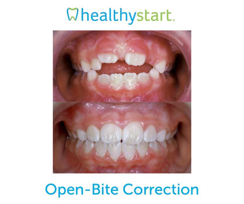 Kids Braces Mission Viejo