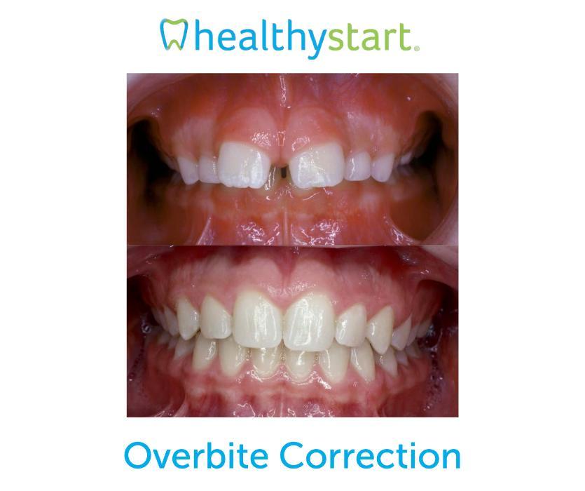 What is an Overbite and How is it Corrected? - Westermeier Martin Dental  Care