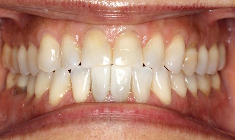 Excess Dental Space Treatment