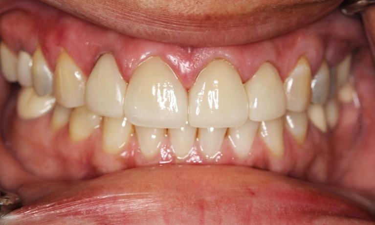 dental-veneers-mission-viejo