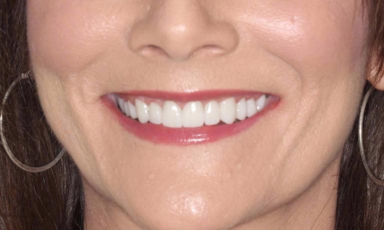 Full-Arch-Maxillary-Rehabilitation-After-Image