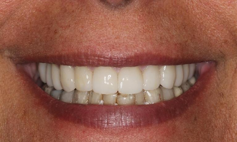 Full-Arch-Maxillary-Rehabilitation-After-Image