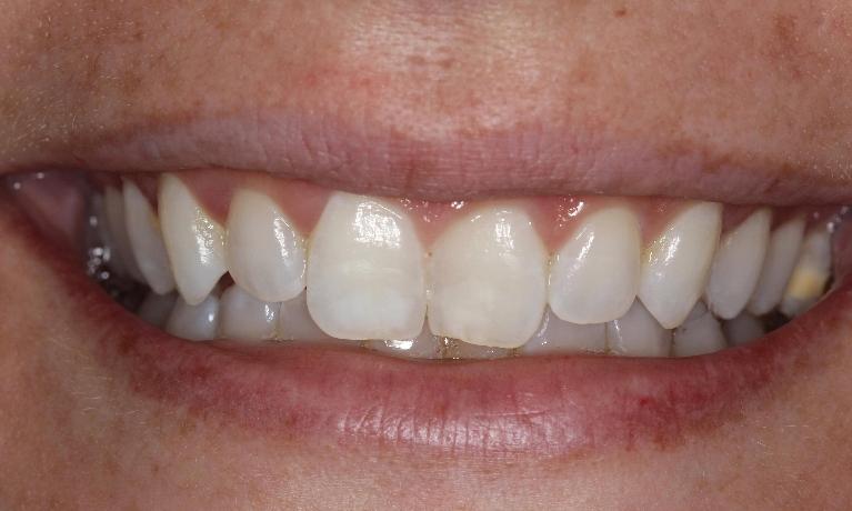 ICON-fix-front-tooth-white-spots