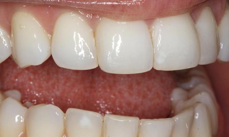 Closing Dental Space Mission Viejo