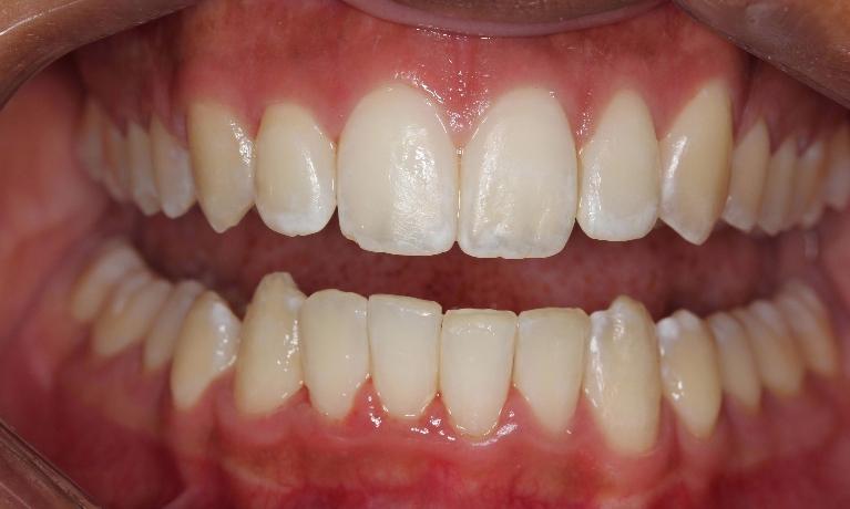 Teeth-Straightening-After-Image