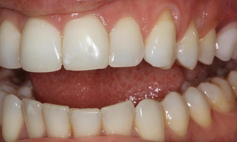 Invisalign Alternative Mission Viejo