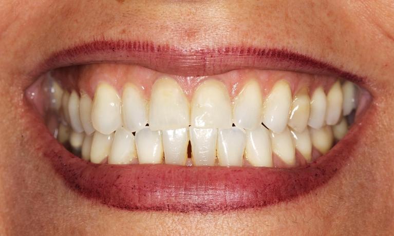 Cosmetic Dentistry Gum Recession Treatment