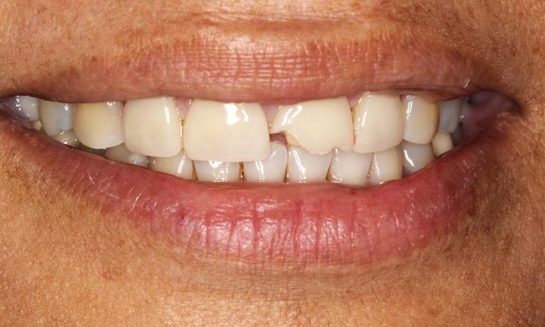 dental-veneers-orange-county
