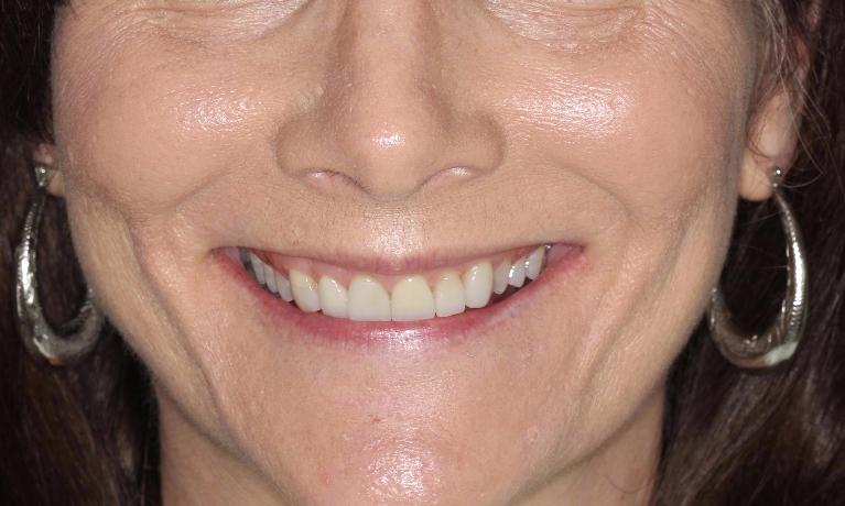 Full-Arch-Maxillary-Rehabilitation-Before-Image