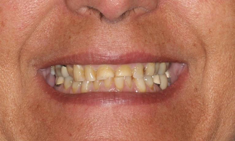 Full-Arch-Maxillary-Rehabilitation-Before-Image