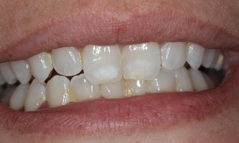 ICON-non-invasive-white-spots