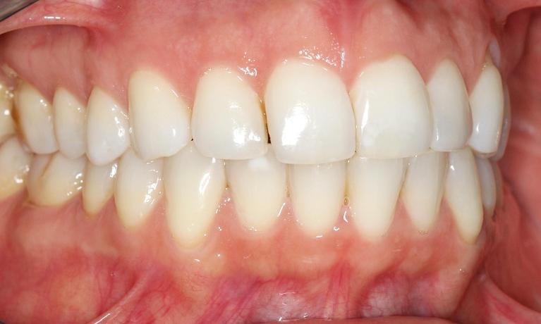 Closing Spaces In Teeth Mission Viejo