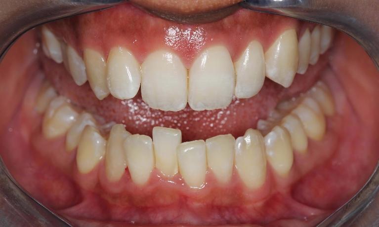 Teeth-Straightening-Before-Image