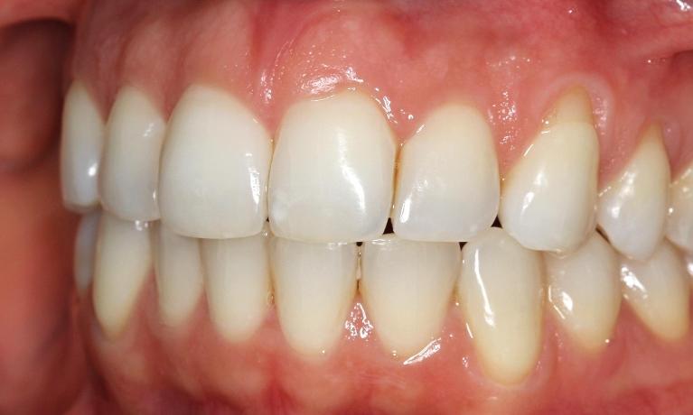 Braces Alternative Mission Viejo